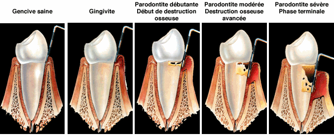 Dentiste Lebrun Thierry : Parodontiste